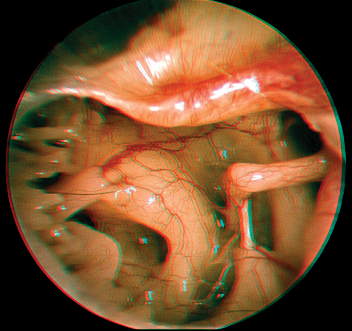 ApoClear Optic Technology - Before